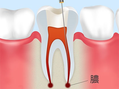 根管治療が必要なのはどんな虫歯？
